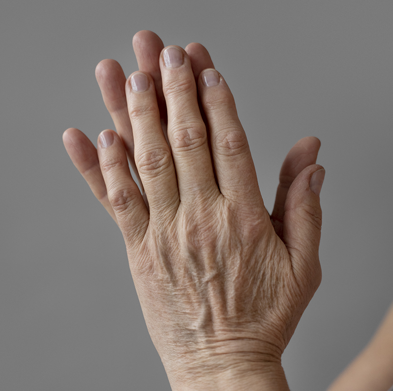Qué es la artrosis de mano