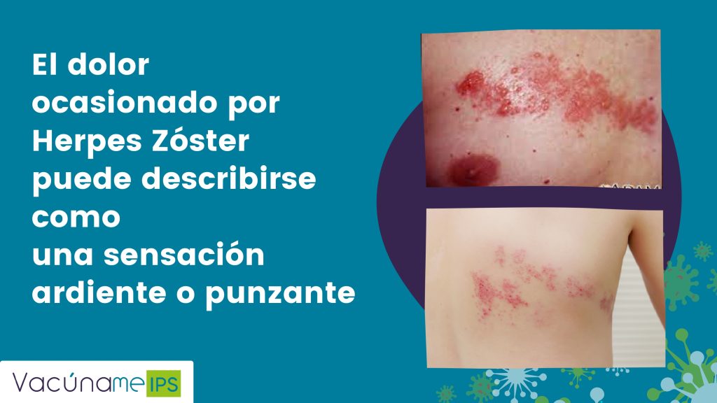 Herpes zoster (1)_page-0001