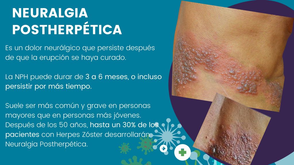 Herpes zoster (1)_page-0011