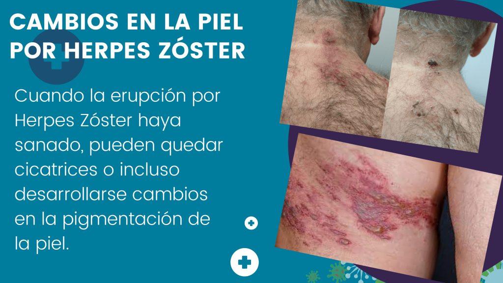 Herpes zoster (1)_page-0012