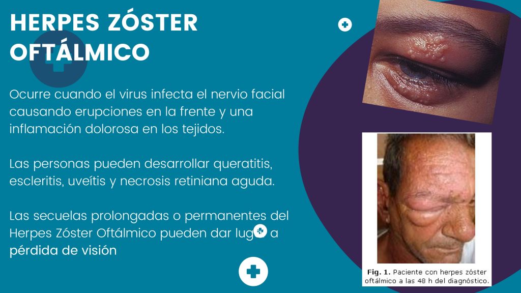 Herpes zoster (1)_page-0013