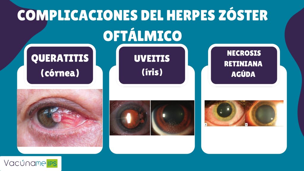 Herpes zoster (1)_page-0014